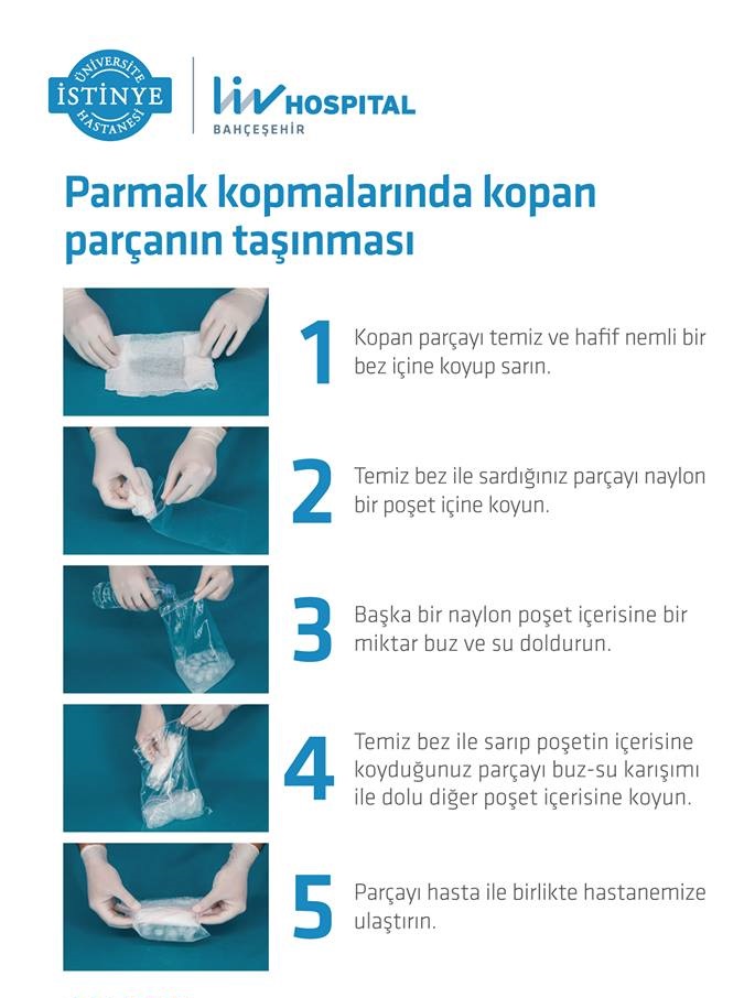 Parmak kopması